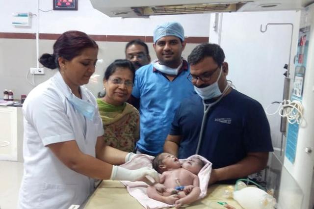 标题：惊喜变惊吓：印度21岁妈妈以为生下双胞胎却是连体儿